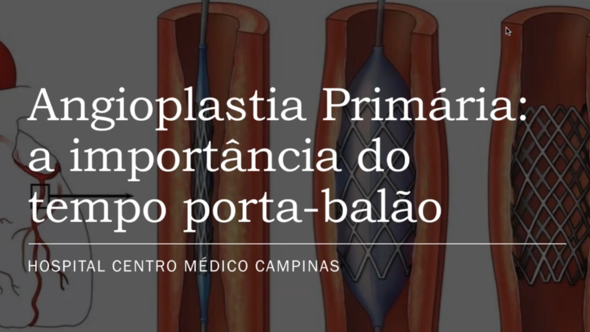 LIVE - Angioplastia primária a importância do tempo porta-balão